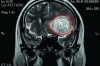 Phát hiện sớm u não nhờ công nghệ chụp MRI