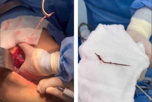Phẫu thuật lấy dị vật hy hữu dài 7cm trong gan của bệnh nhân