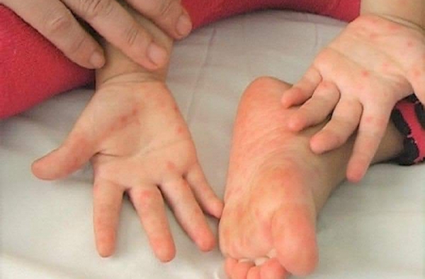 Bệnh tay chân miệng, cha mẹ nên biết để phòng ngừa cho trẻ
