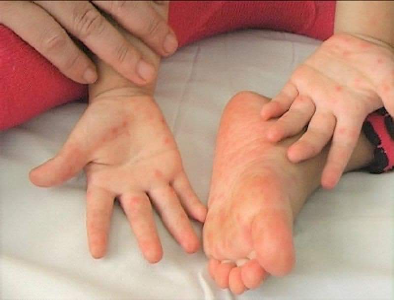 Bệnh tay chân miệng, cha mẹ nên biết để phòng ngừa cho trẻ