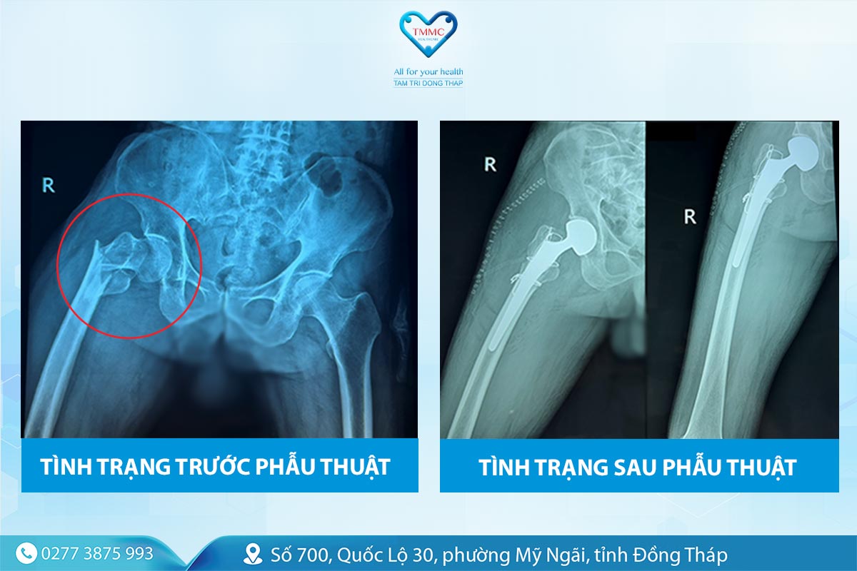 trYYc_va_sau_khi_phYu_cas_82t_1