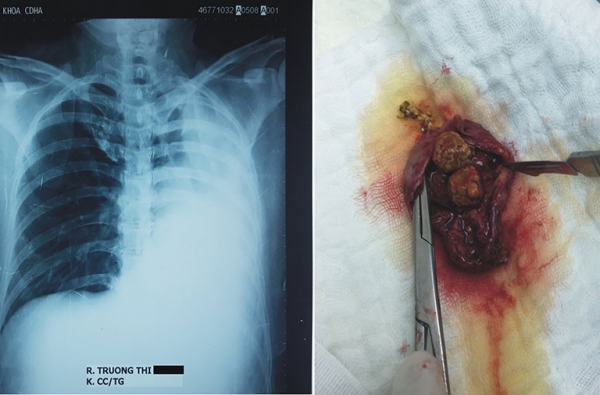 Phẫu thuật cắt túi mật nội soi do sỏi trên bệnh nhân chỉ có 1 lá phổi