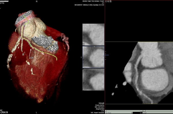 Nhiều người bệnh biết sớm nguyên nhân nhồi máu cơ tim cấp nhờ Chụp CTscan mạch vành