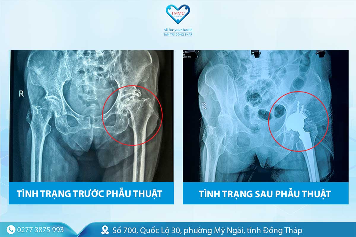 trYYc_va_sau_khi_phYu_cas_82t