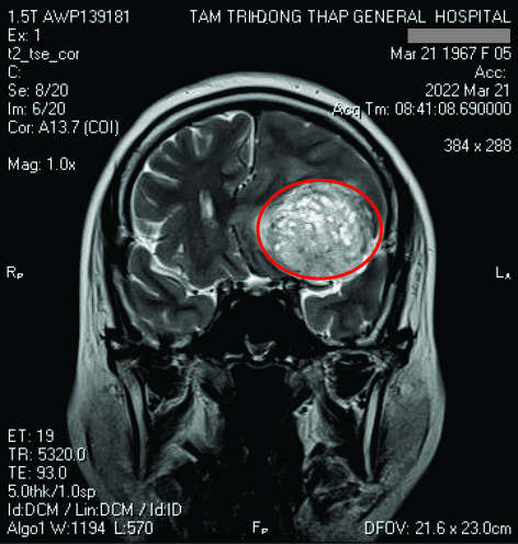 Phát hiện sớm u não nhờ công nghệ chụp MRI