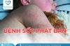 Bệnh sốt phát ban