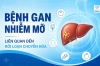 Bệnh gan nhiễm mỡ liên quan đến rối loạn chuyển hóa
