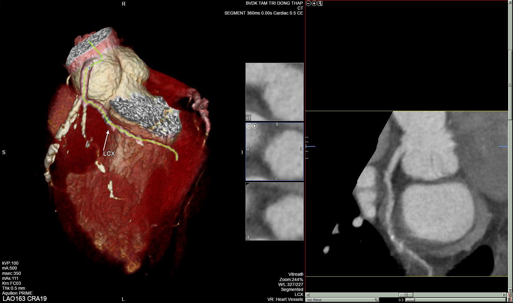 Nhiều người bệnh biết sớm nguyên nhân nhồi máu cơ tim cấp nhờ Chụp CTscan mạch vành