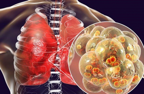 4 dấu hiệu cảnh báo căn bệnh ung thư phổi đang tấn công cơ thể, đừng coi thường kẻo mất mạng