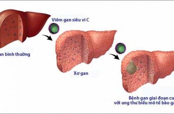Tầm soát vi rút viêm gan C (Screening for Hepatitis C Virus)