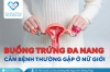 Buồng trứng đa nang: Căn bệnh thường gặp ở nữ giới