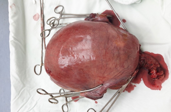 Phẫu thuật thành công u xơ tử cung nặng 3,9 kg