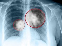 Những quan niệm sai lầm về ung thư phổi “ai cũng cho là đúng”