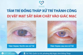 BVĐK Tâm Trí Đồng Tháp xử trí thành công ca dị vật mạt sắt bám chặt vào giác mạc