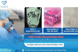 Tâm Trí Đồng Tháp phẫu thuật nội soi thành công trường hợp tắc ruột do xương cá