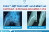Phẫu thuật thay khớp háng bán phần được BHYT hỗ trợ, giảm gánh nặng chi phí cho người bệnh