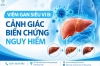 Viêm gan siêu vi B: Cảnh giác nguy cơ và biến chứng